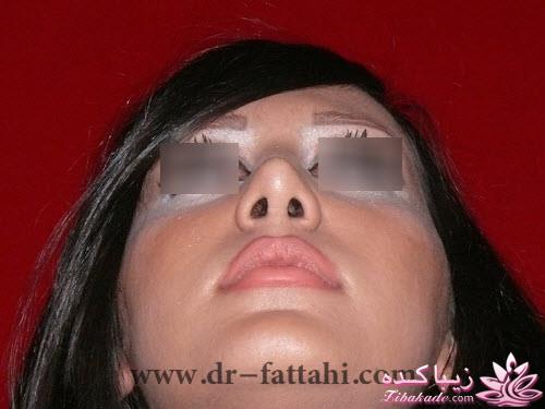 جراحی بینی - جراحی زیبایی